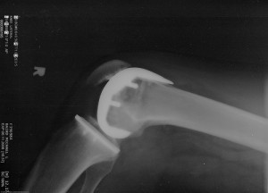 Arthritis